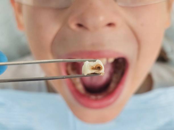 Best Emergency Broken Tooth Repair in Marshall, MI